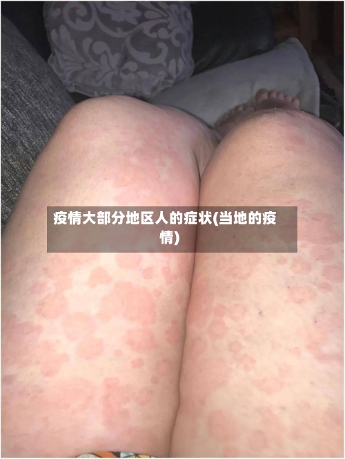 疫情大部分地区人的症状(当地的疫情)-第1张图片
